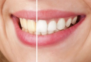 Sposoby na wybielanie zębów