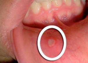 Domowe sposoby na afty - rozwiąż problem naturalnie