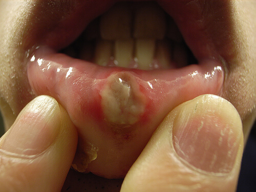 Afta na ustach