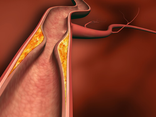 3#:Miażdżyca-cholesterol.jpg