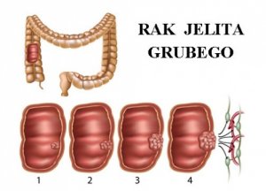 Rak jelita grubego – Jak się ustrzec?