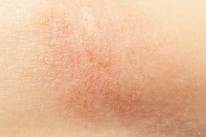 7 naturalnych sposobów na suchą skórę
