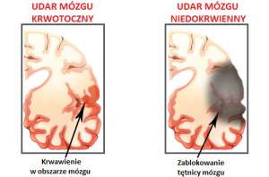 Udar mózgu - objawy i przyczyny