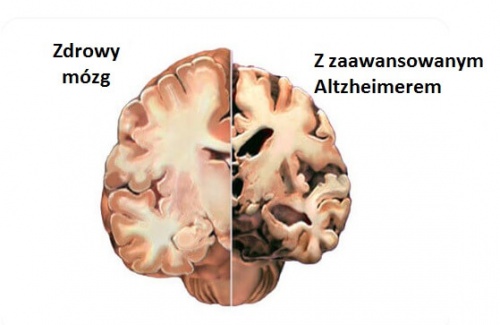 1#:Alzheimer-pierwsze-symptomy-choroby.jpg