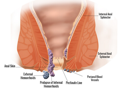 Schemat tworzenia się hemoroidów