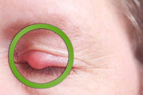 Jęczmień jak szybko go wyleczyć? Domowe sposoby