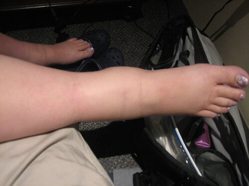 Opuchnięte kostki i stopy