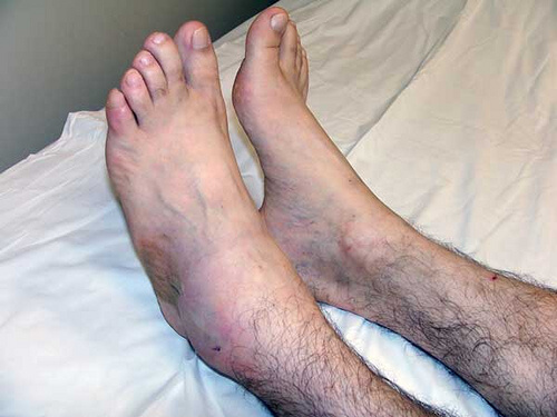 Opuchlizna na kostce