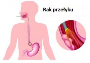 Przełyk – Objawy najczęstszych chorób