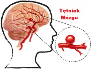 Tętniak mózgu - czym jest i jak mu zapobiec?