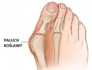 Paluch koślawy - dlaczego powstaje?