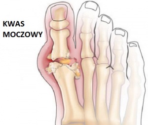 Niebezpieczny kwas moczowy – zmniejsz jego ilość