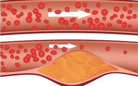 Cholesterol w tętnicach