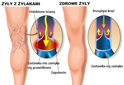 2#:żylaki.jpg