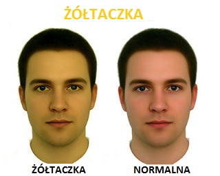 żółtaczka