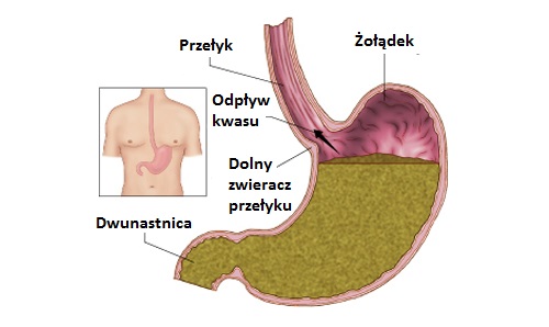 refluks żołądkowo-jelitowy