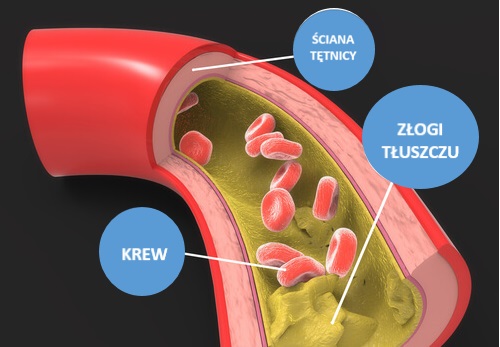 1#:jak-obnizyc-poziom-cholesterolu/.JPG