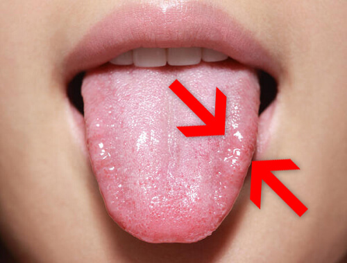 Kandydoza jamy ustnej - naturalne leczenie