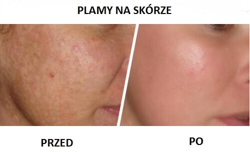 Plamy na skórze usuń przy pomocy wody utlenionej