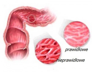 Zespół drażliwego jelita - czego nie jeść