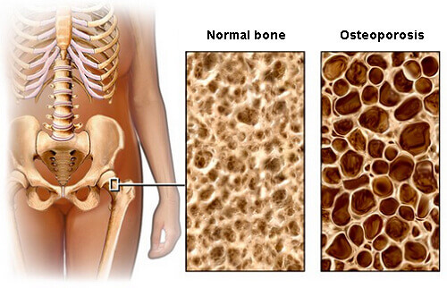 Poznaj porady dietetyczne pozwalające zapobiec osteoporozie