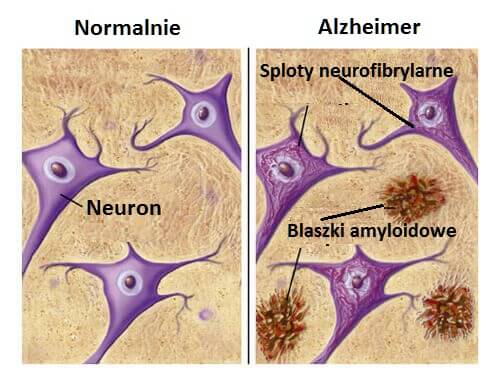 Produkty, które cię ochronią przed Alzheimerem!