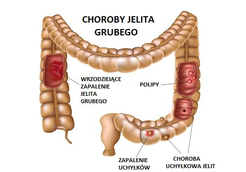 Choroby jelita grubego