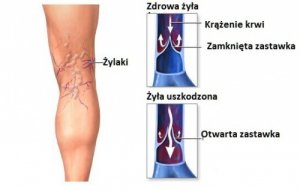 Żylaki – skuteczne sposoby na ich leczenie