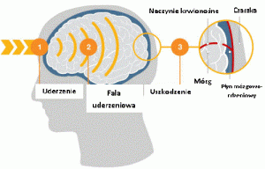 Chroń swój mózg i unikaj urazów głowy!