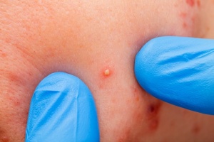 Pryszcze: jak im skutecznie zapobiegać?