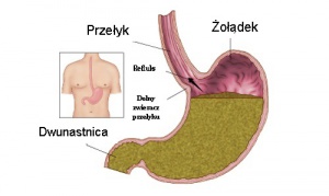 Refluks żołądka - jak mu zaradzić?