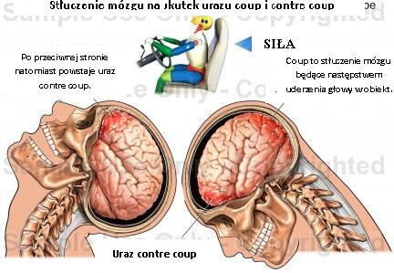 2#:Urazy mózgu-mózg.jpg