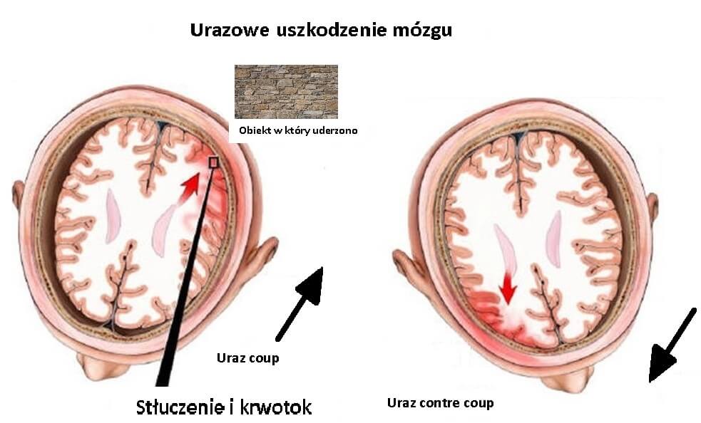 3#:uderzenie-mózg.jpg