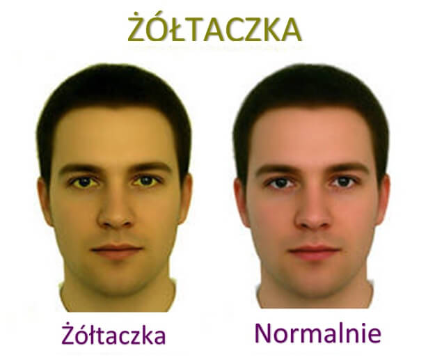 Żółtaczka