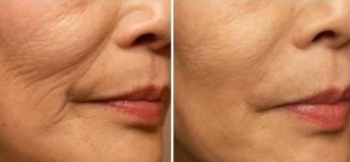 Zmniejsz zmarszczki poprzez ćwiczenia na ujędrnienie skóry twarzy