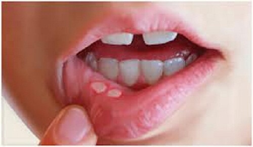 Afty w jamie ustnej - zapobieganie i leczenie