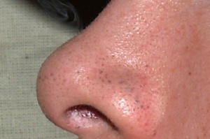 7 sposobów na pozbycie się zaskórników