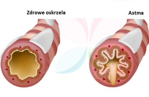 Astma – jakie produkty powinniśmy spożywać?