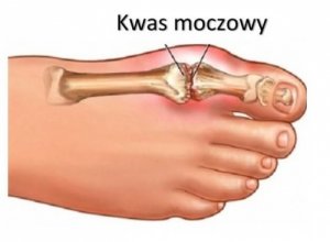 Obniżamy kwas moczowy — owocami!
