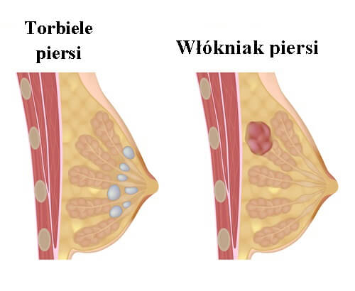 2#:Torbiele w piersi-piersi.jpg
