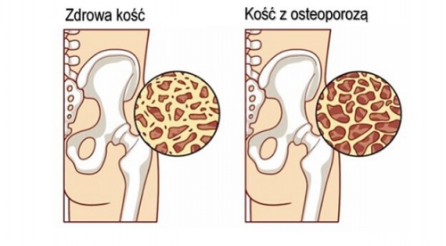 Osteoporoza – kontrolowanie w okresie menopauzy