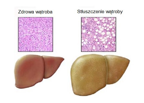 stłuszczenie wątroby