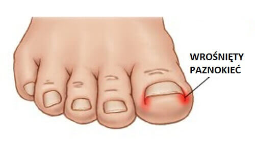 Wrośnięty paznokieć