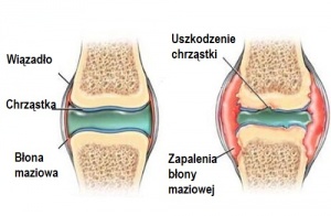 Chrząstka - jak zapobiegać jej bólom?