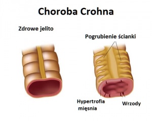 Choroba Crohna: objawy i leczenie