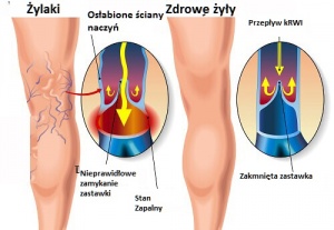 Ćwicz i pozbądź się żylaków
