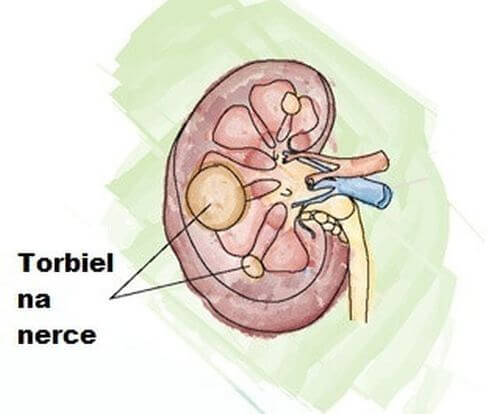 Torbiel na nerce