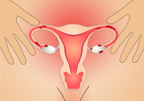 Endometrioza: złagodź jej objawy odpowiednią dietą