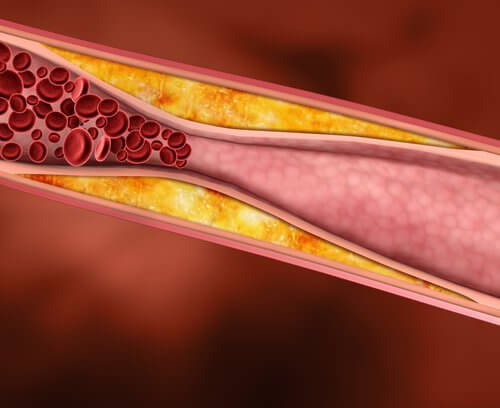 Cholesterol na ścianach tętnicy