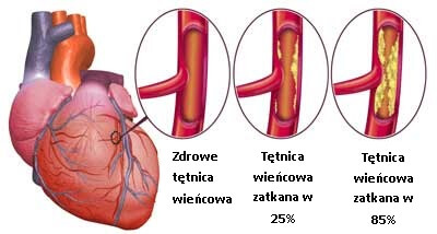 3#:Niewydolnosc serca-choroby serca.jpg